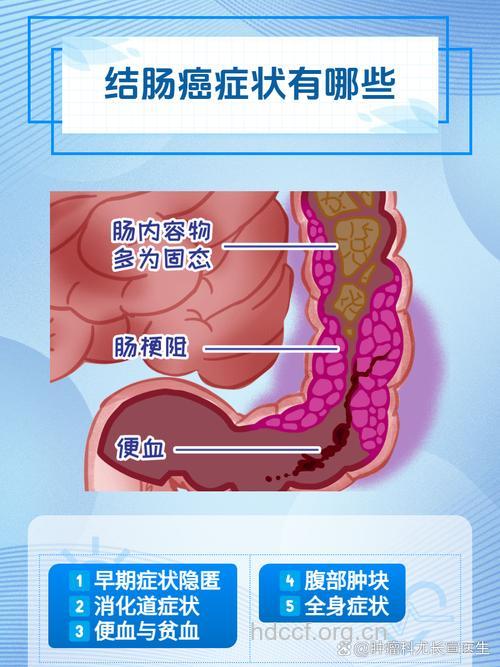 易患大肠癌的6类人