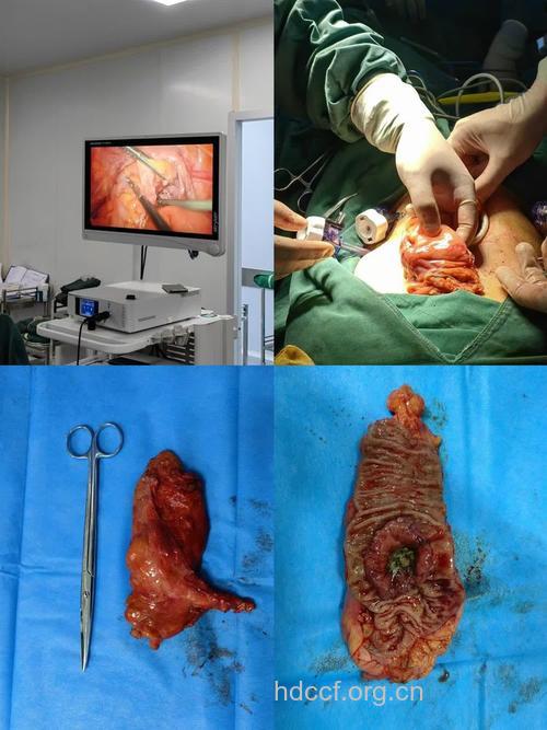 手术治疗大肠癌