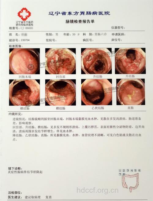 内镜下的大肠癌早期诊断