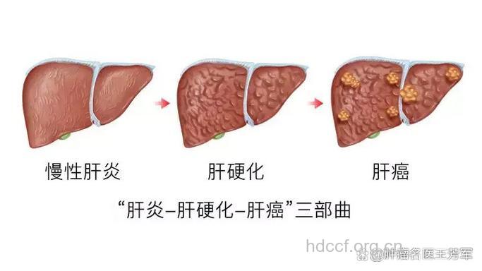 乙型肝炎转为肝癌可能与X蛋白突变有关