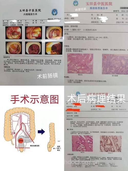 诊断直肠癌的方法有哪些？