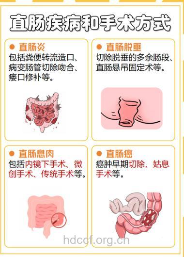 关于直肠癌切除术患者的研究
