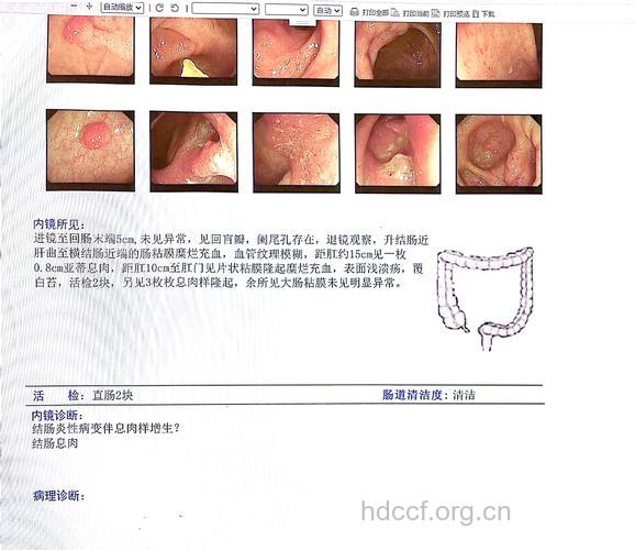 用“纸片”就能查出大肠癌?