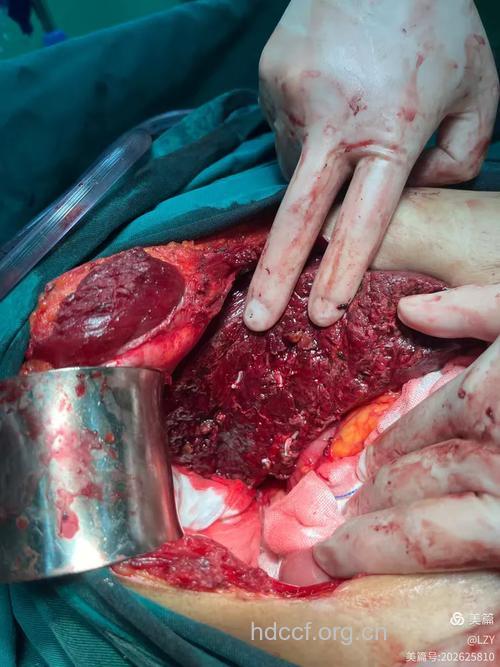 肝癌的手术治疗