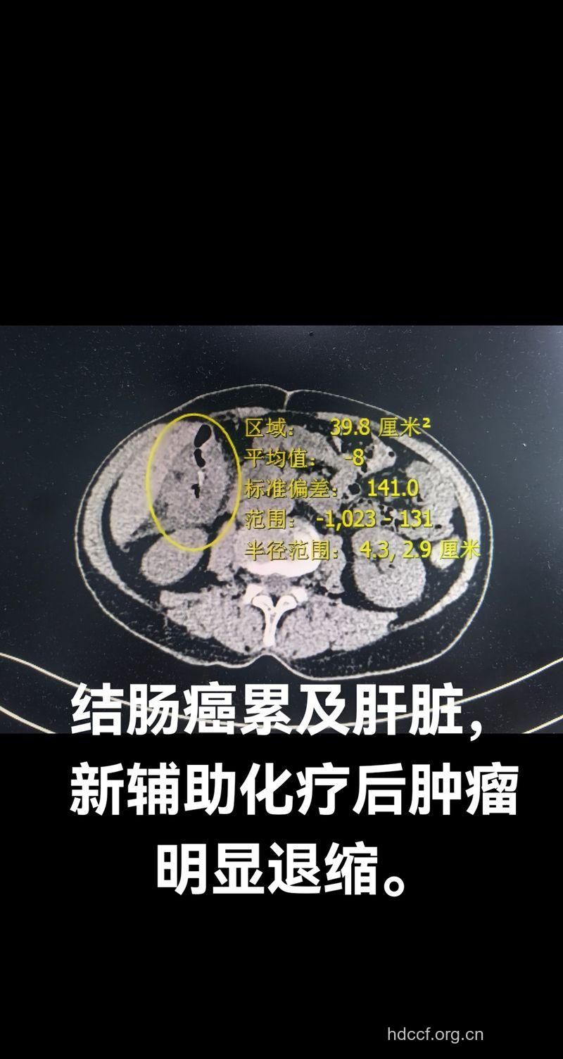 检查结肠癌也可用CT