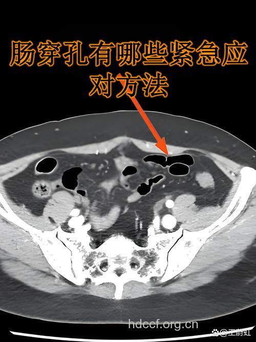 盘点:结肠癌性穿孔的类型