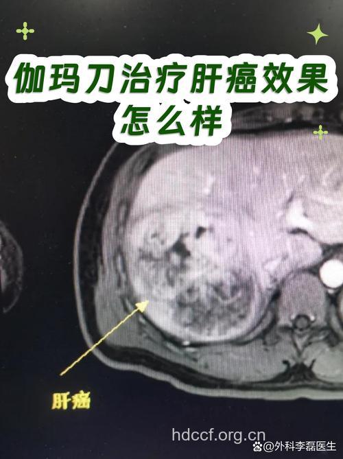 肝癌的治疗方法 手术和放射效果好