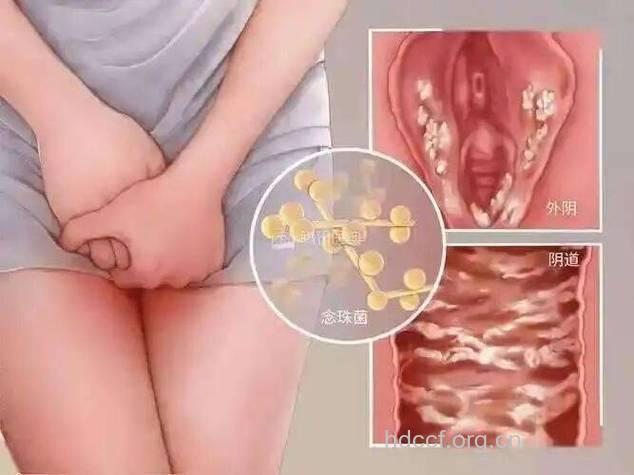 女性阴道炎是什么引起的呢?