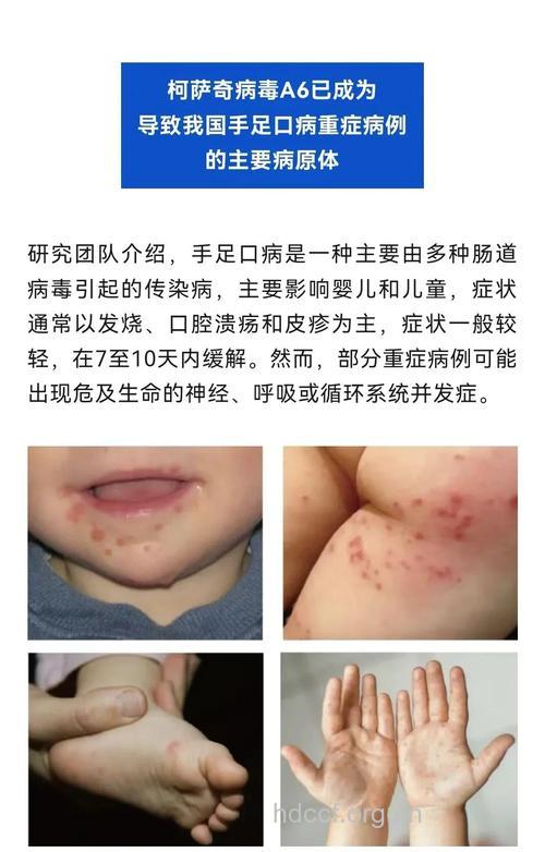 小孩得了手足口病怎么办?