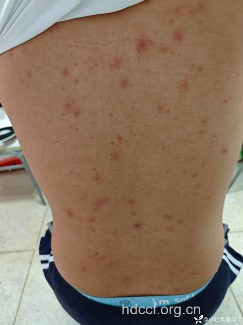 肝癌早期患者会出现发热症状