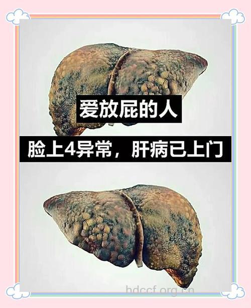 忍屁不放小心肝癌找上门