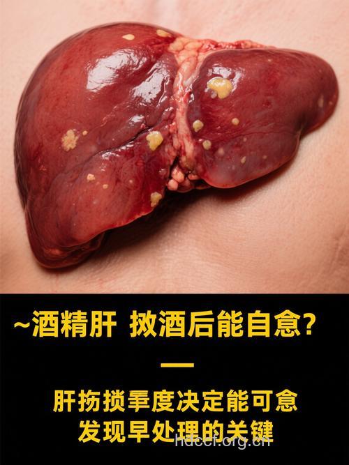 酒精可泡出肝癌