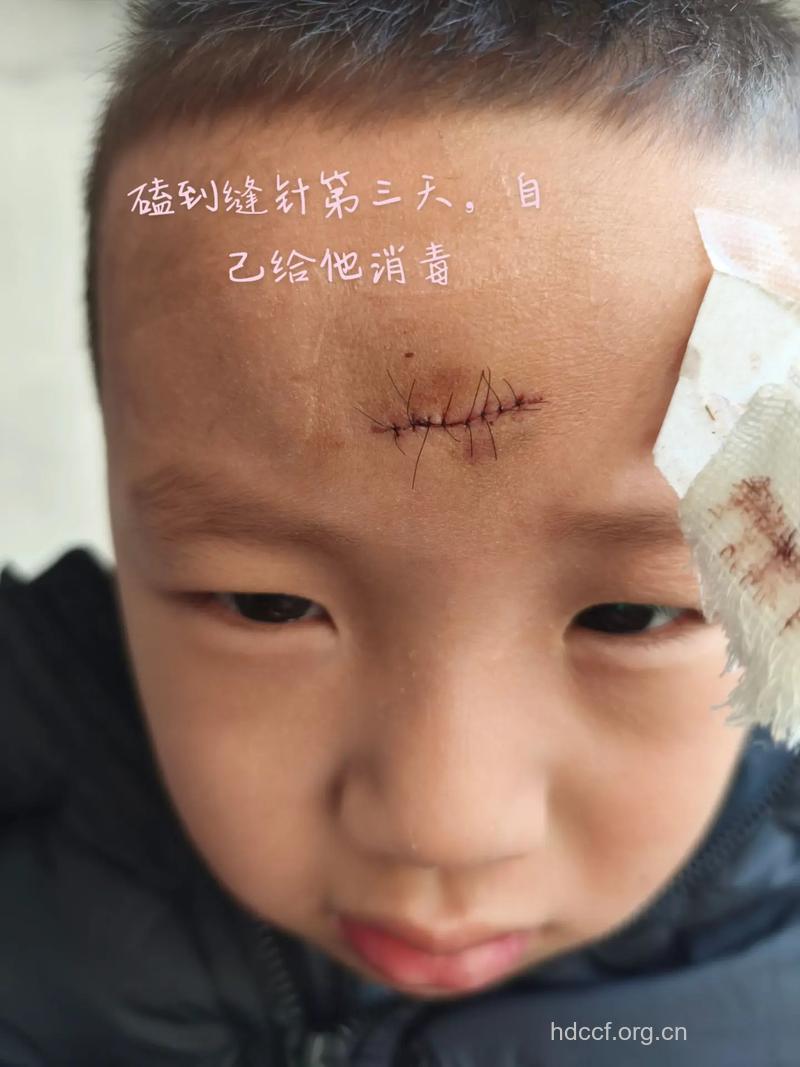 儿童头部受伤如何处理