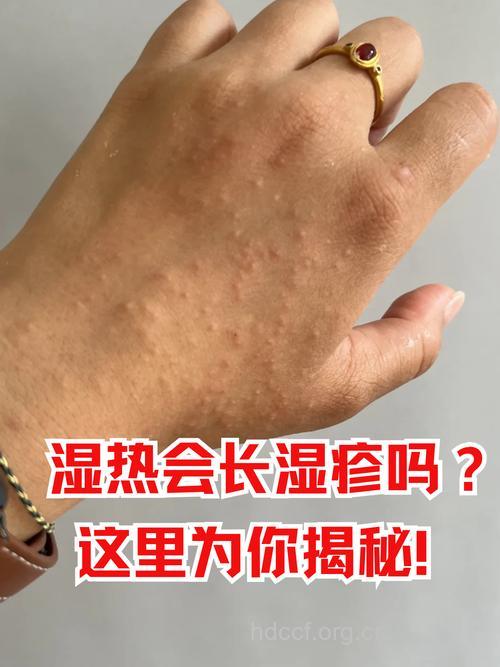 皮肤爱长痘长湿疹 大都是脾胃出问题