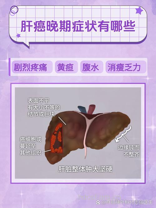 肝癌的发病倾向是什么