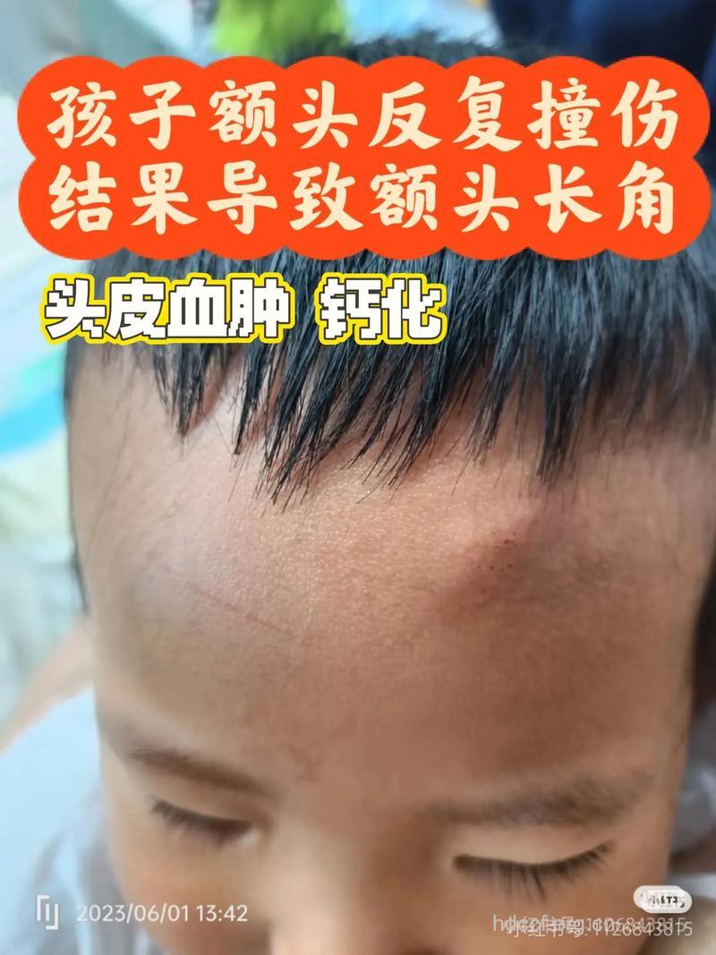 头部起“包”该怎样处理