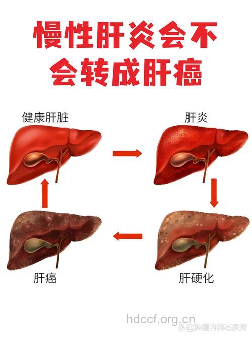 得了肝炎会不会变成肝癌