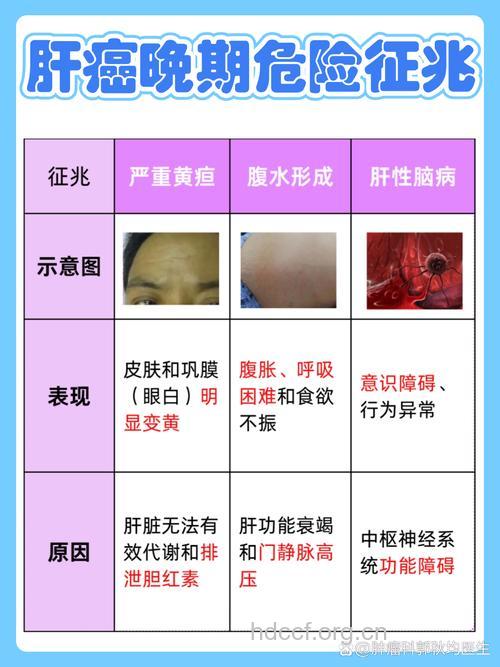 肝癌的五大早期症状