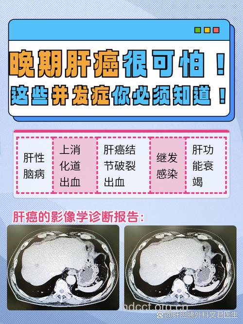 原发性肝癌晚期会出现的并发症