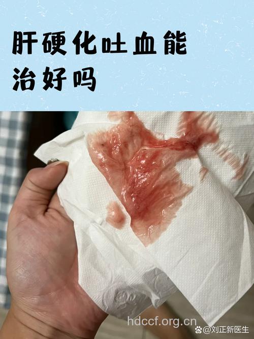 肝癌患者出血症状是怎么回事