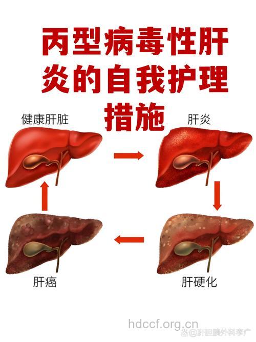 丙肝早期患者怎么护理