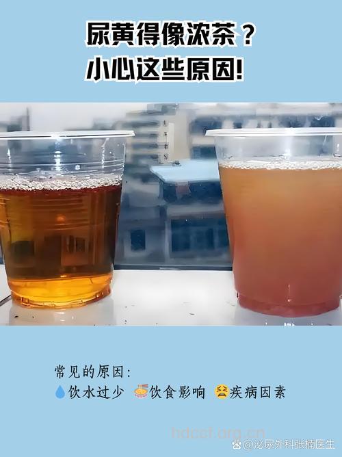 小便如浓茶样是丙肝症状吗