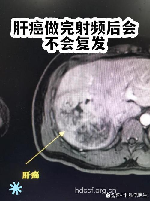 肝癌手术后会不会复发