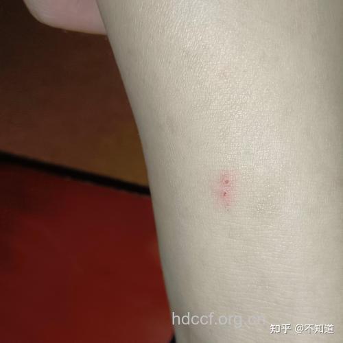 皮肤破损被宠物舔小心感染狂犬病