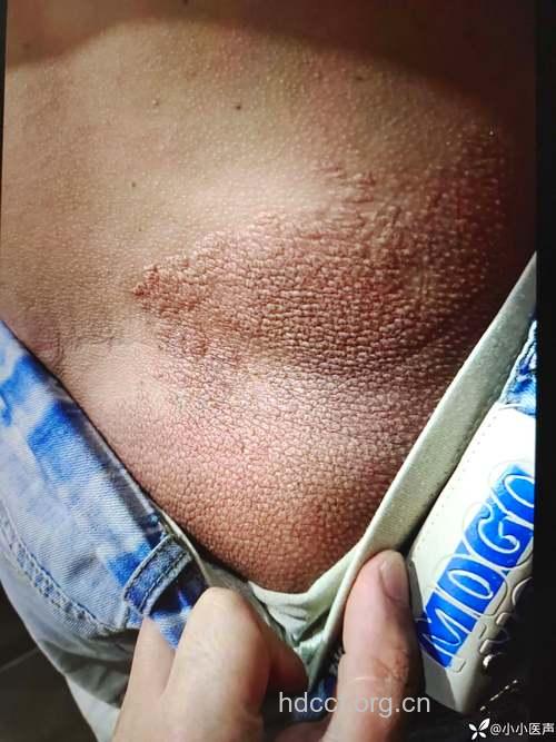 女性肝癌早期腰背部症状最明显