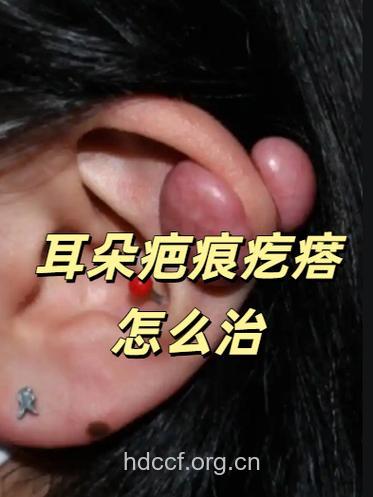 耳外伤延期不治注意警惕癌变