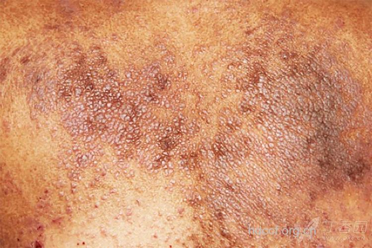 丙肝的早期有哪些症状