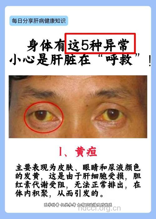 疾病百科 黄疸型肝炎是什么疾病