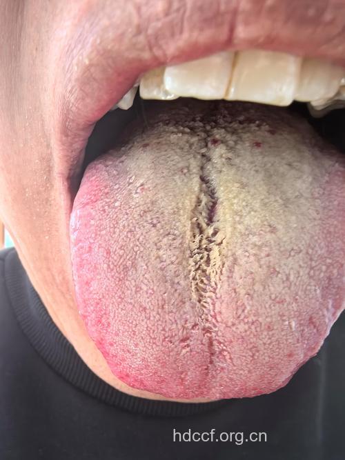 湿热的症状 舌苔黄腻身热口干