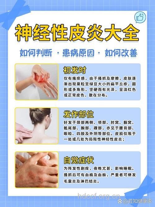 中医治疗神经性皮炎的方法