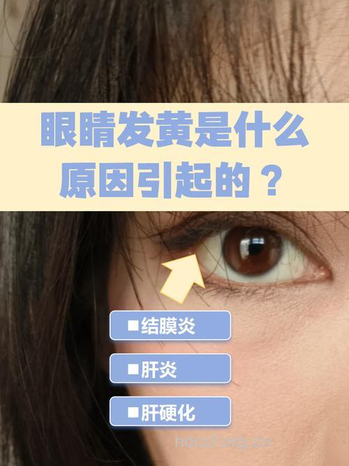 眼睛发黄是为什么