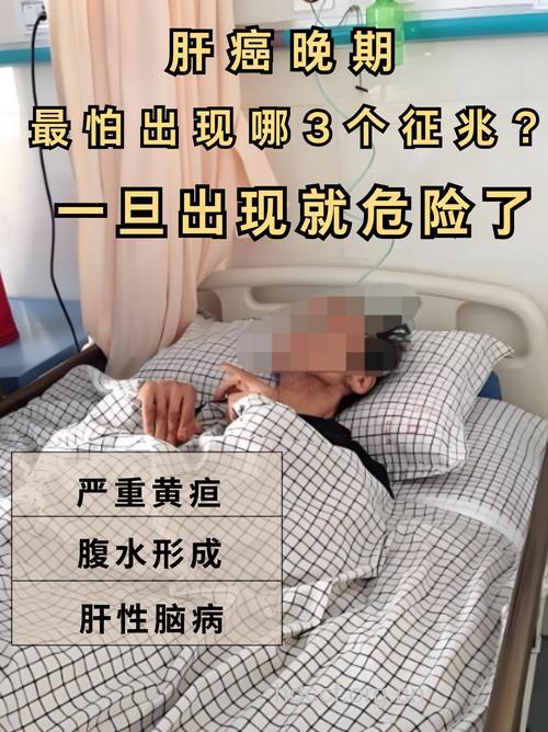 肝癌的晚期症状