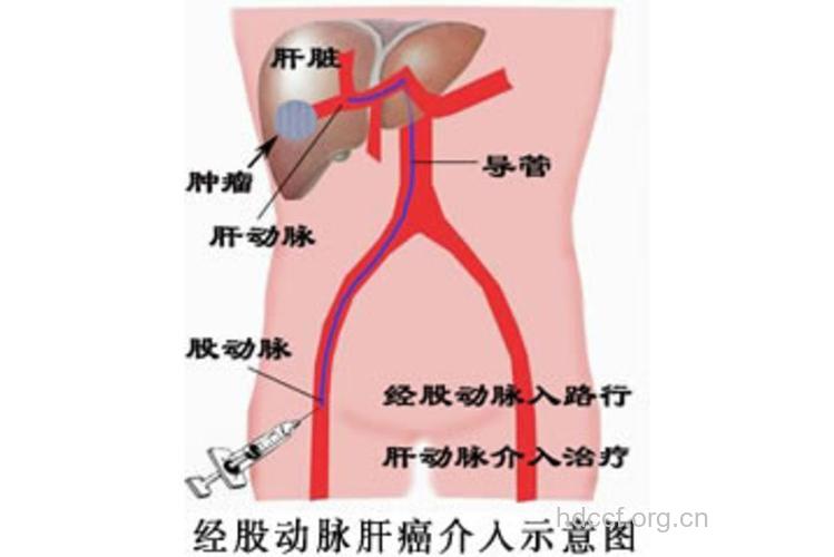 什么是肝癌的介入治疗
