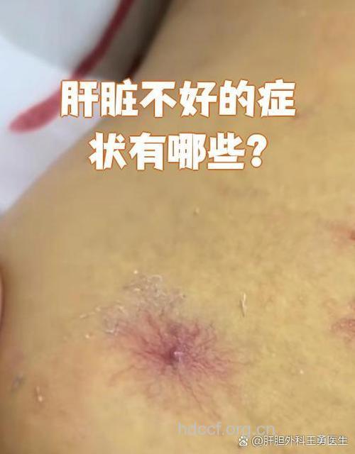 男性肝癌的早期症状