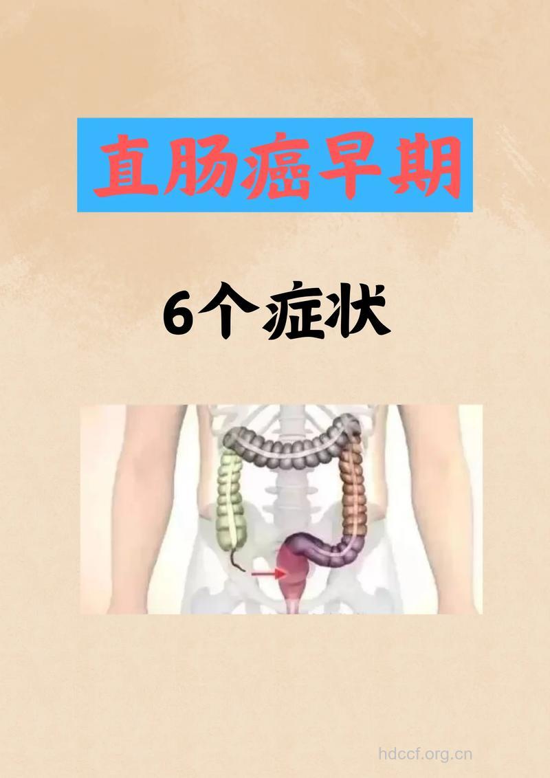 肠癌的早期症状