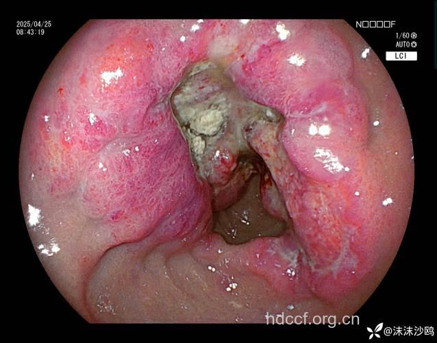 胃癌的早期症状