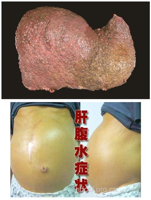 肝癌会出现水肿的症状吗