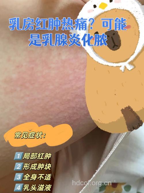 乳腺炎的早期症状