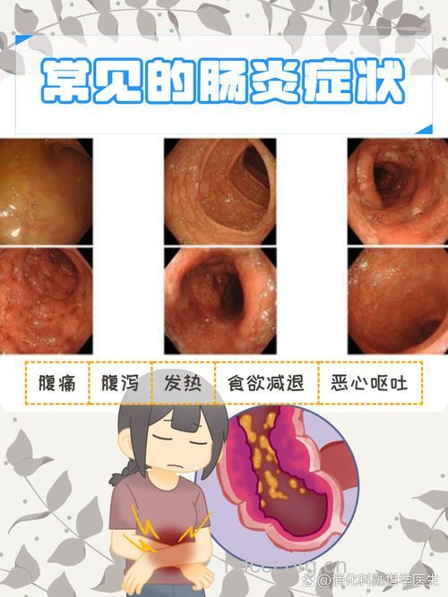 结肠炎的早期症状