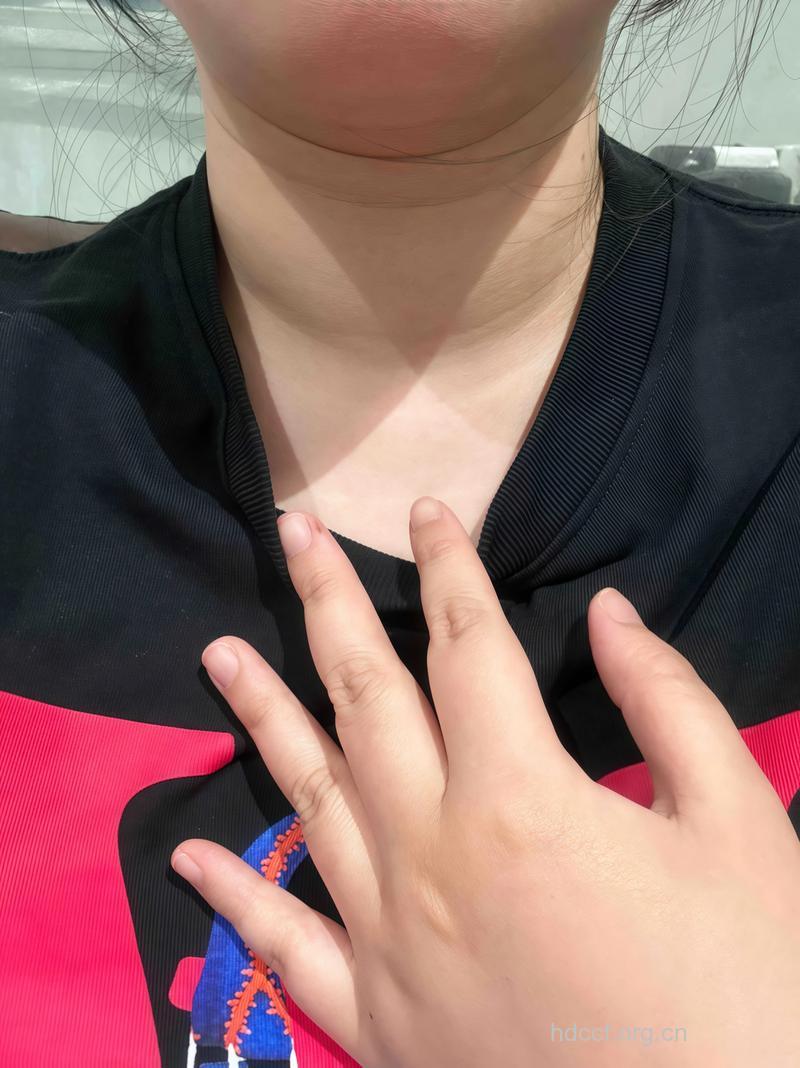 甲亢的早期症状