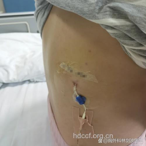 肝癌术后导致胸腔积液