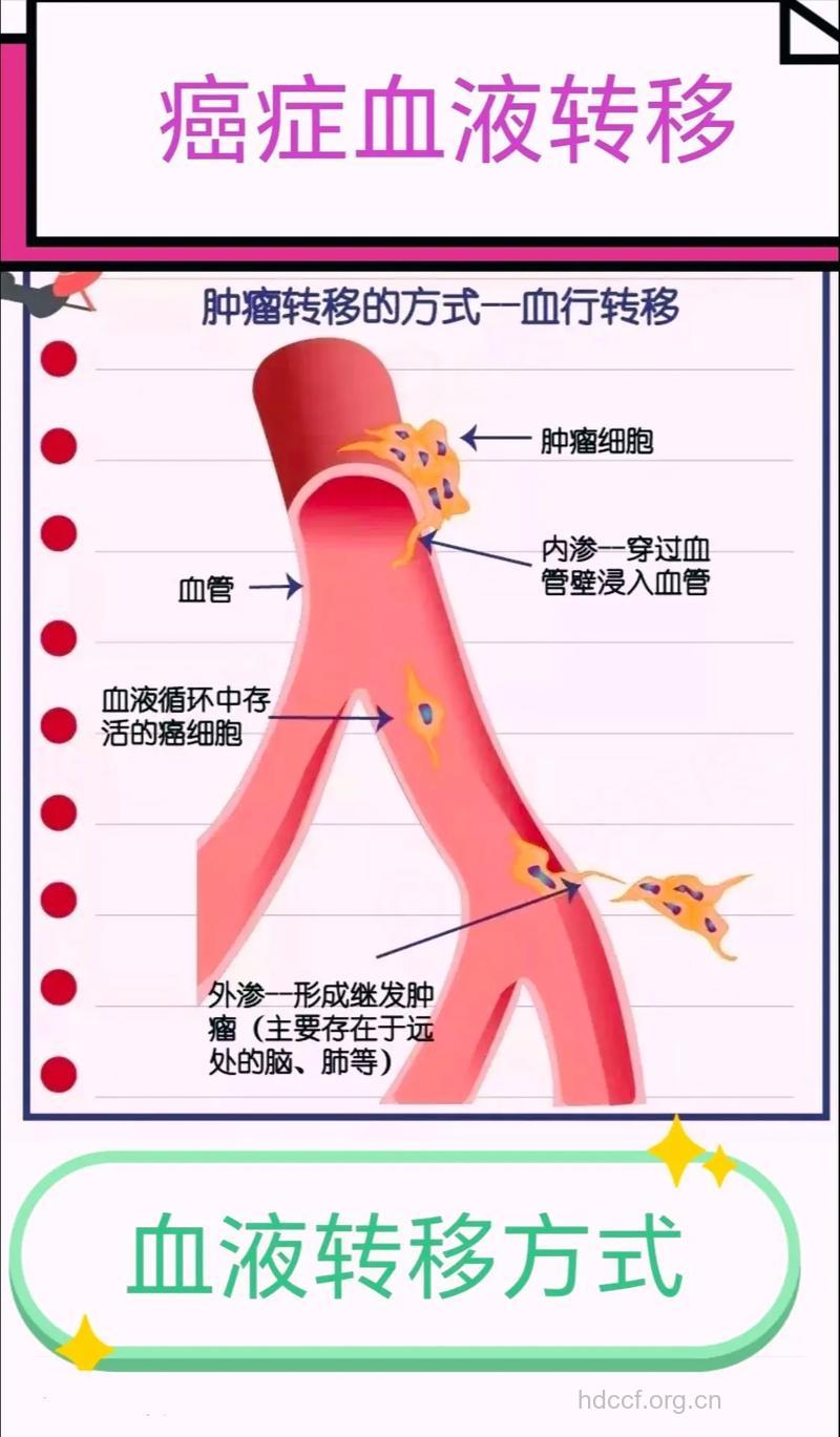 晚期肝癌会发生转移吗