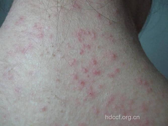 肝癌患者的全身症状是什么