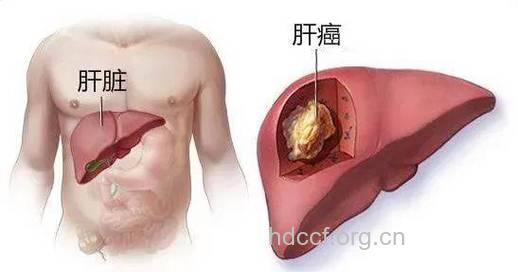 到底什么是肝癌呢