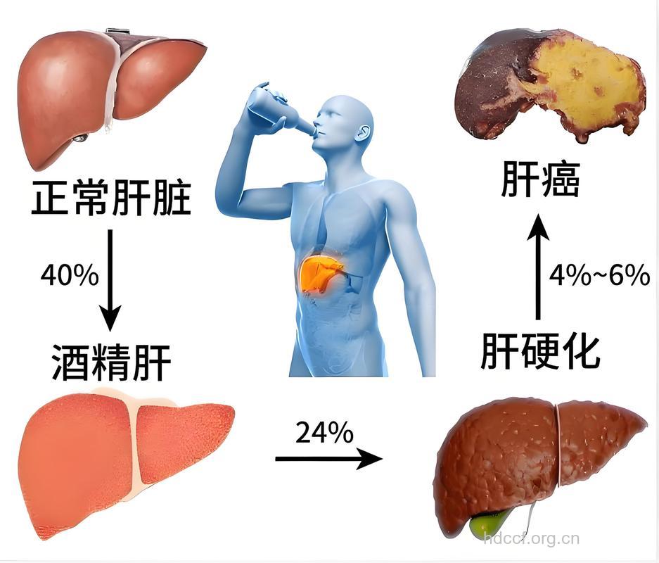 导致肝癌的凶手是哪些