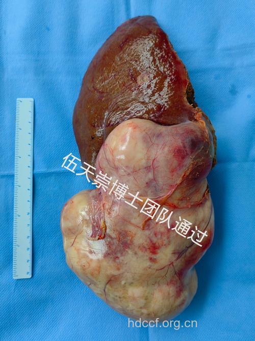 肝上的肿瘤到底能不能切?